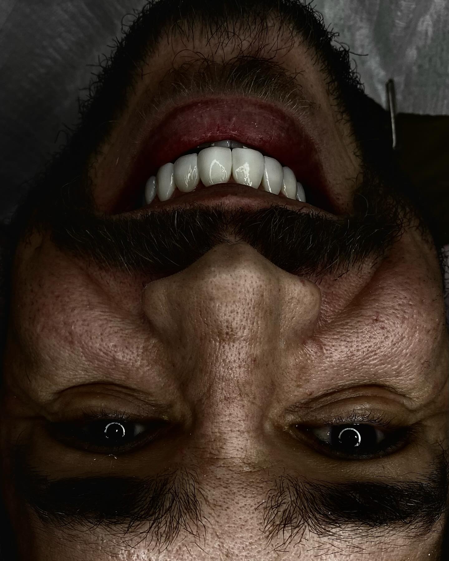 Resultado de lentes em resina