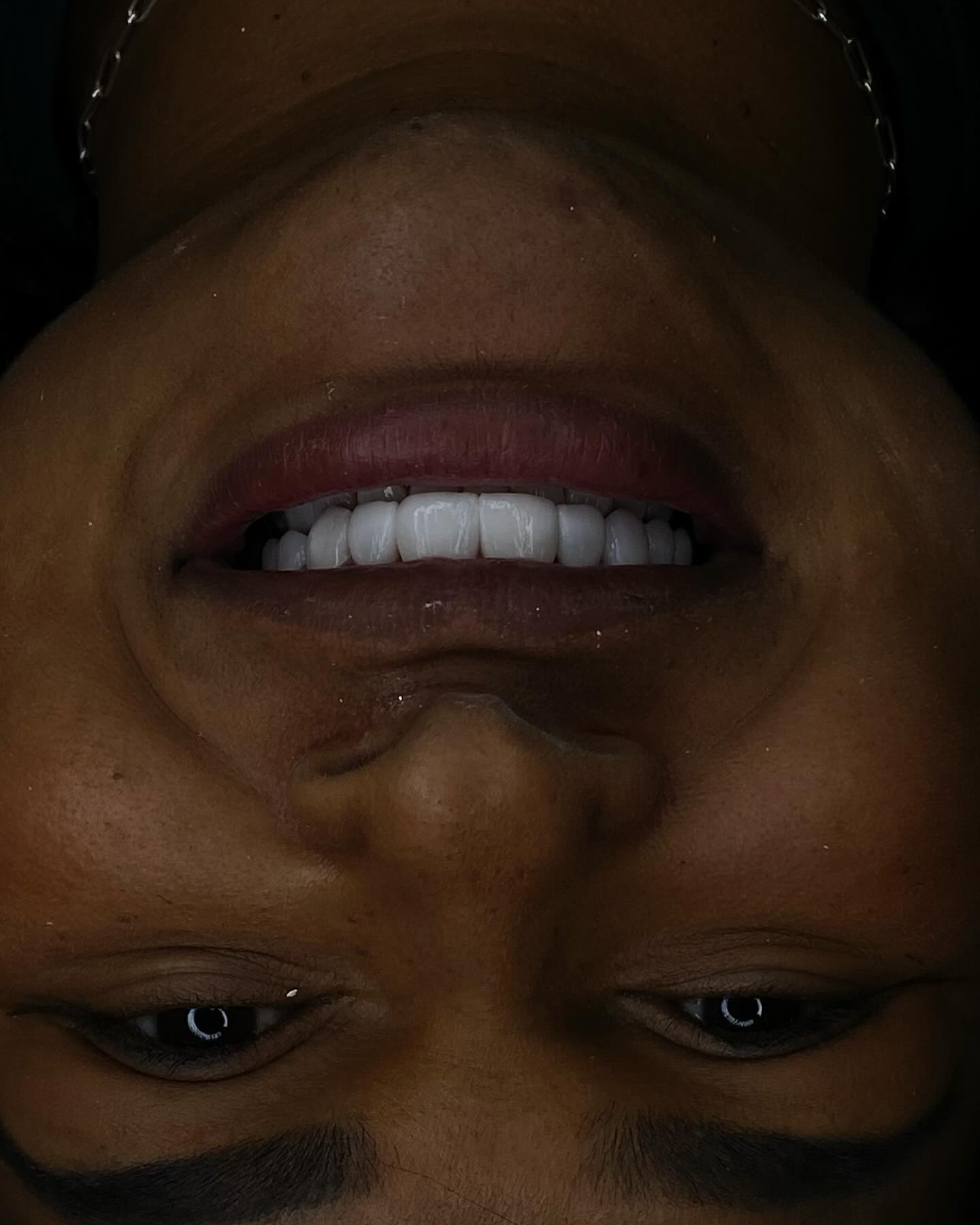 Transformação com implantes