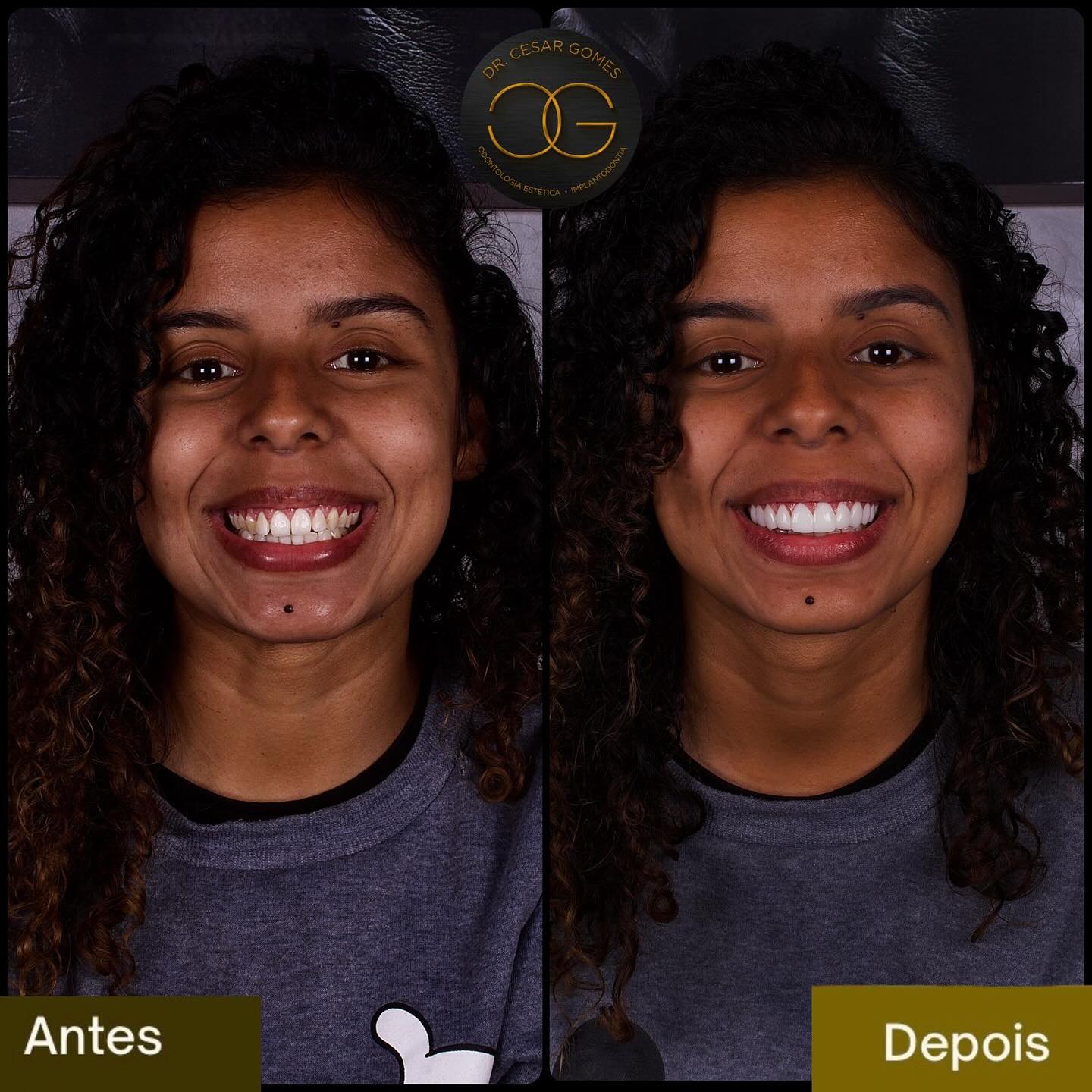 Transformação completa do sorriso - Antes e Depois