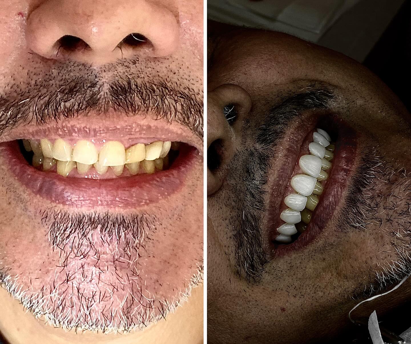 Reabilitação oral completa